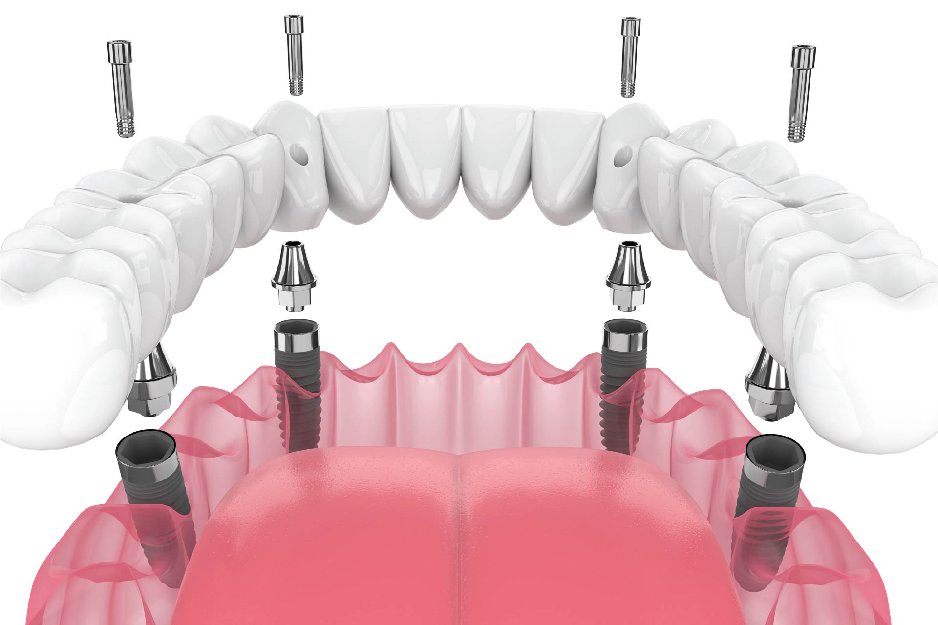 All-on-4 Implants: A Natural Way to Restore Your Smile