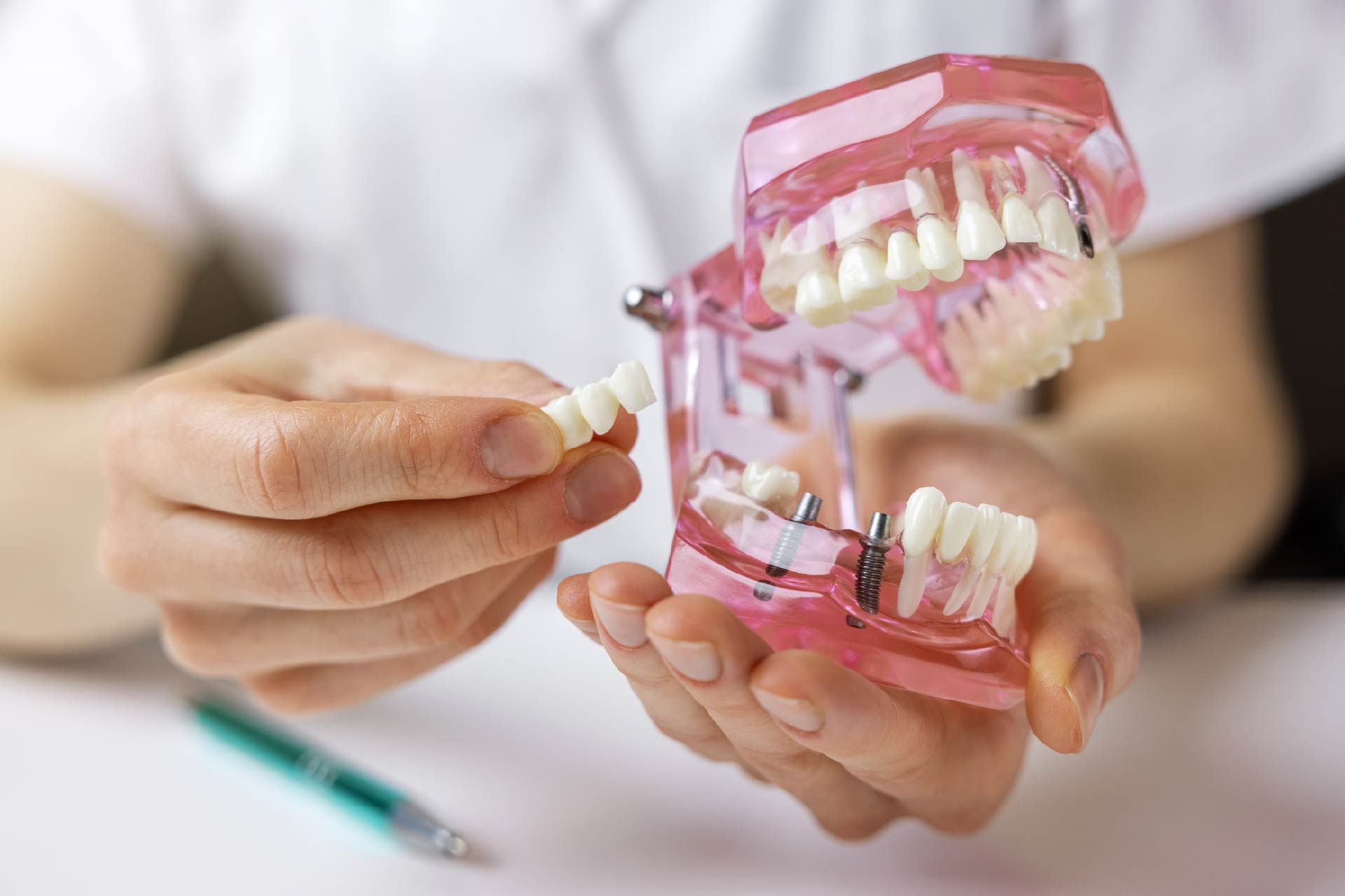 Why Dental Implants are a Good Choice for You